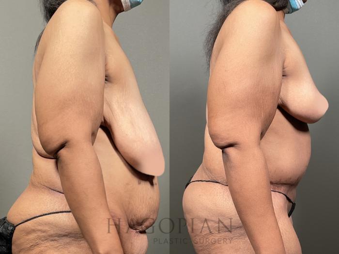 Before & After Breast Reduction Case 49 Right Side View in Atlanta, GA