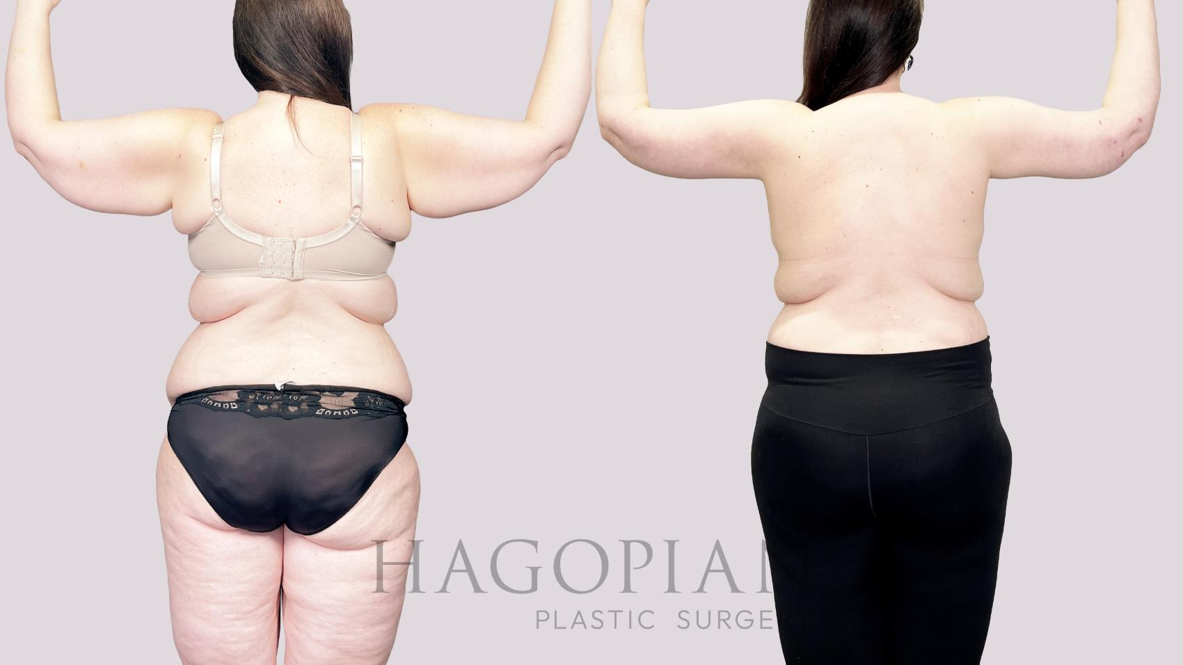 Before & After Mommy Makeover Case 83 Back View in Atlanta, GA