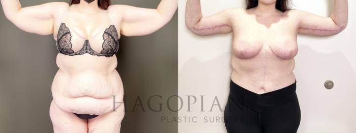 Before & After Drainless Tummy Tuck Case 83 Front View in Atlanta, GA