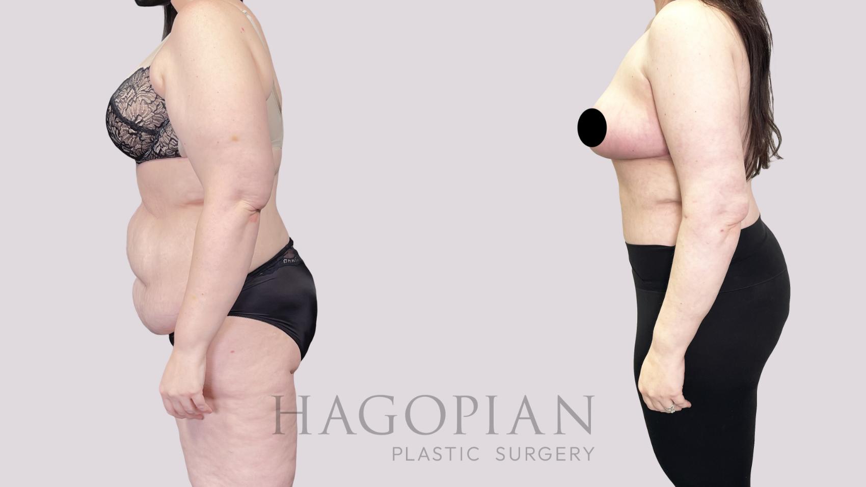 Before & After Drainless Tummy Tuck Case 83 Left Side View in Atlanta, GA