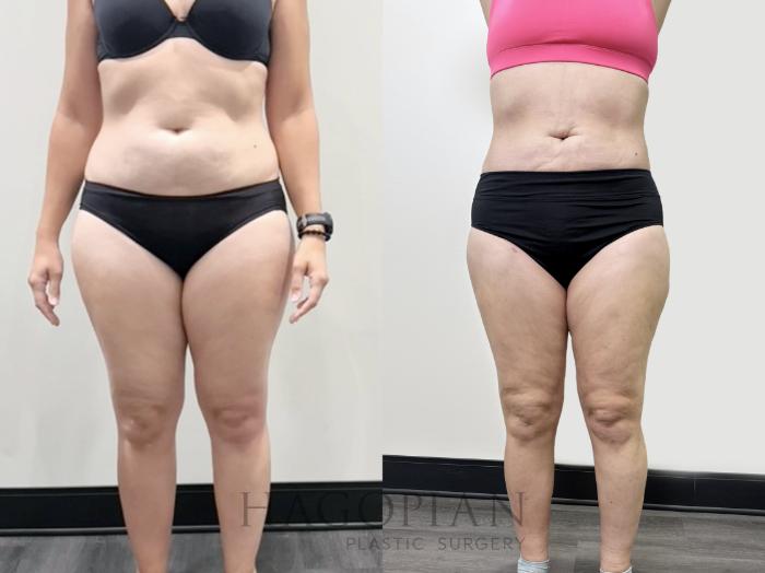 Before & After Lipedema Surgery Case 113 Front View in Atlanta, GA