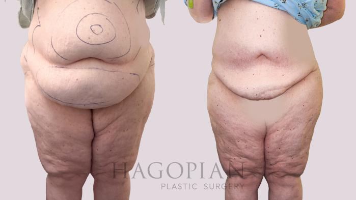 Before & After Lipedema Surgery Case 172 Front View in Atlanta, GA