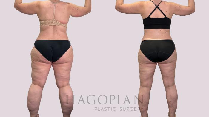 Before & After Lipedema Surgery Case 177 Back View in Atlanta, GA