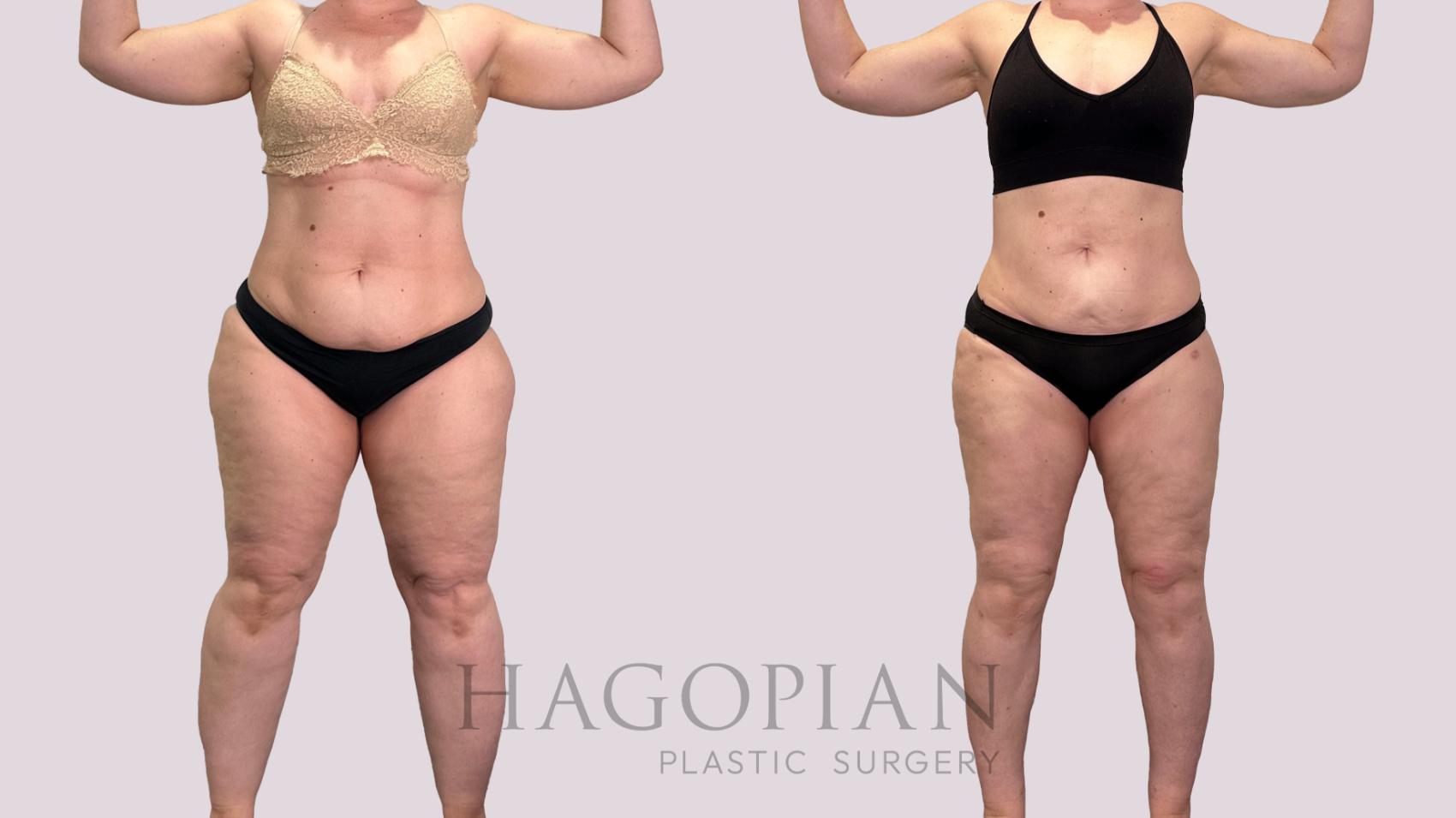 Before & After Lipedema Surgery Case 177 Front View in Atlanta, GA