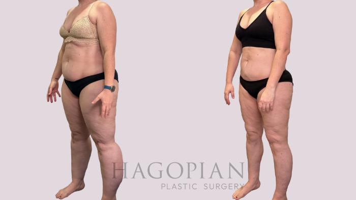 Before & After Lipedema Surgery Case 177 Left Oblique View in Atlanta, GA