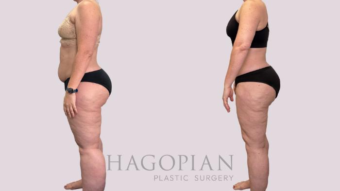 Before & After Lipedema Surgery Case 177 Left Side View in Atlanta, GA