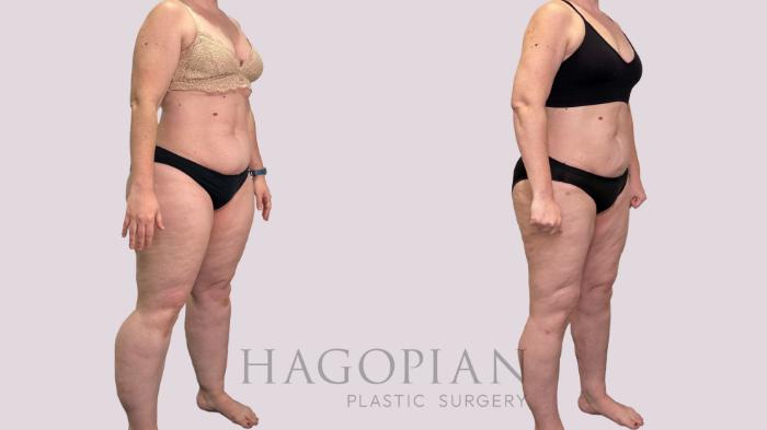 Before & After Lipedema Surgery Case 177 Right Oblique View in Atlanta, GA