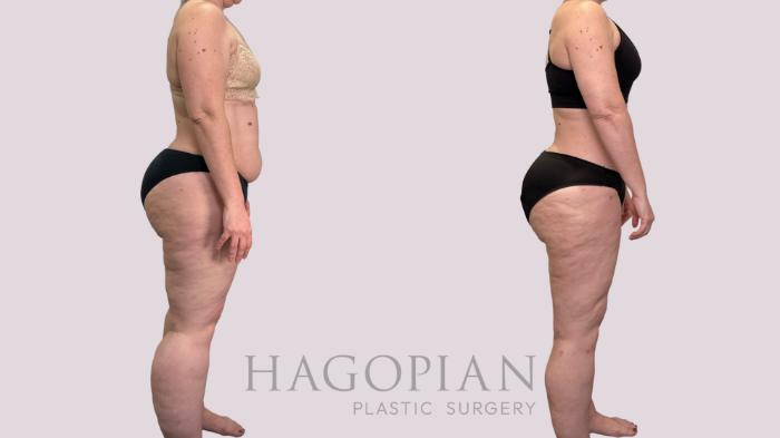 Before & After Lipedema Surgery Case 177 Right Side View in Atlanta, GA