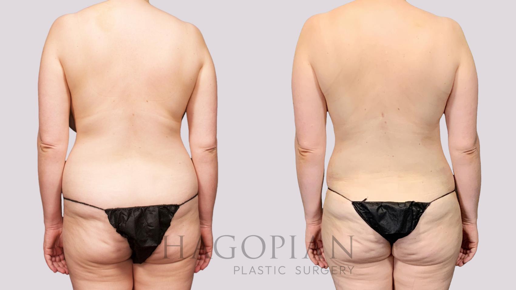 Before & After Liposuction Case 26 Back View in Atlanta, GA