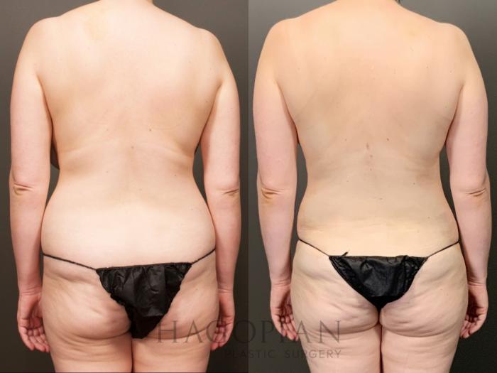 Before & After Breast Reduction Case 26 Back View in Atlanta, GA