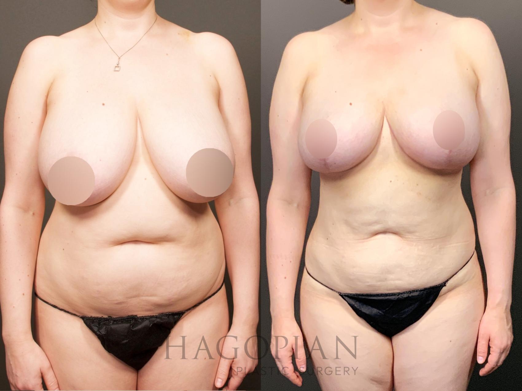 Before & After Breast Reduction Case 26 Front View in Atlanta, GA