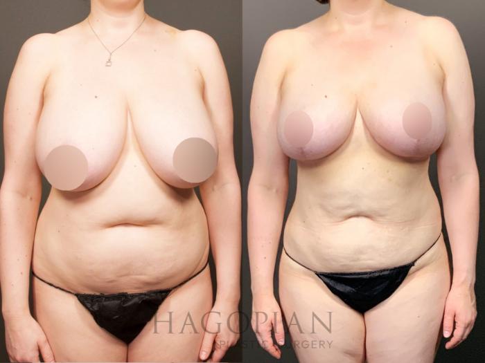 Before & After Breast Lift Case 26 Front View in Atlanta, GA