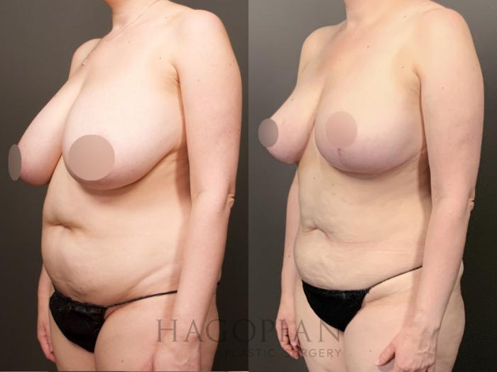 Before & After Breast Reduction Case 26 Left Oblique View in Atlanta, GA