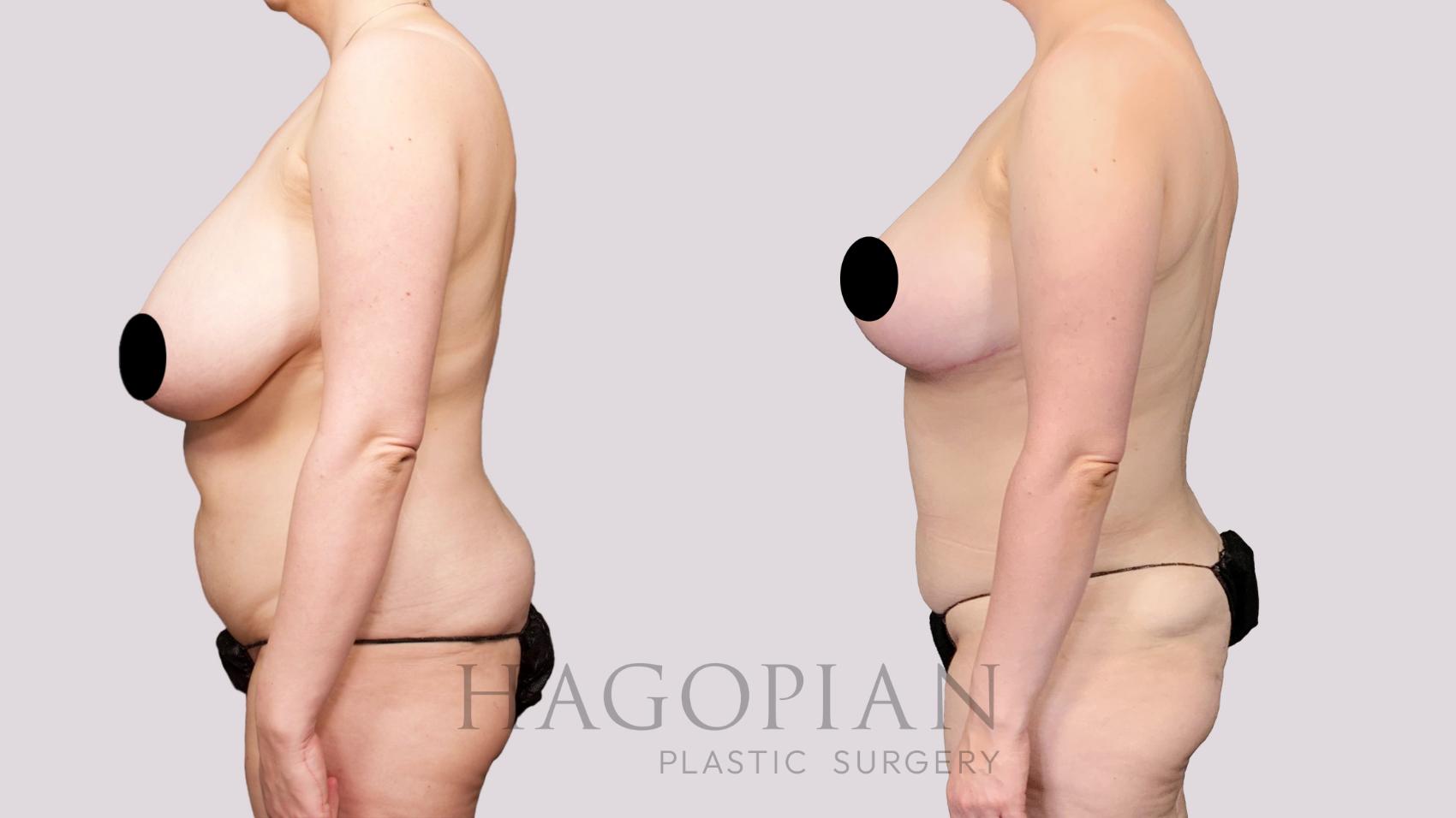 Before & After Liposuction Case 26 Left Side View in Atlanta, GA