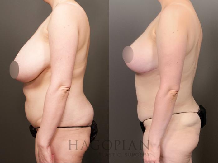 Before & After Breast Reduction Case 26 Left Side View in Atlanta, GA
