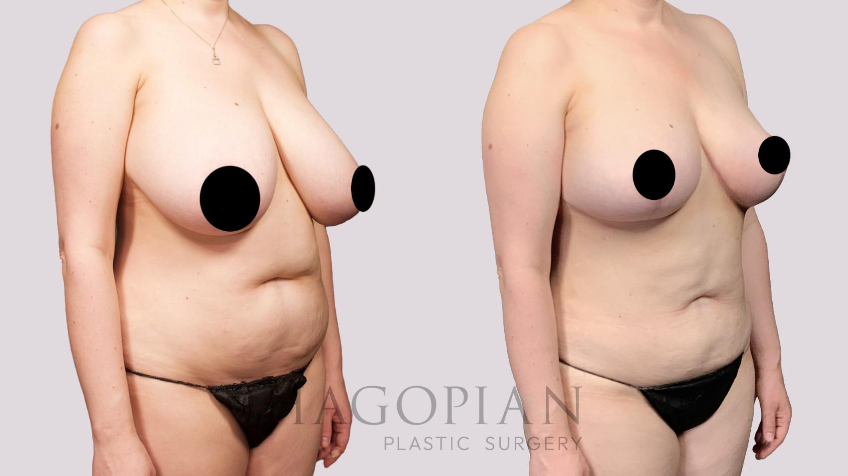 Before & After Liposuction Case 26 Right Oblique View in Atlanta, GA