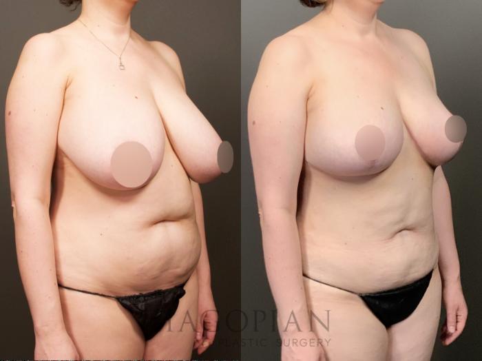 Before & After Breast Reduction Case 26 Right Oblique View in Atlanta, GA