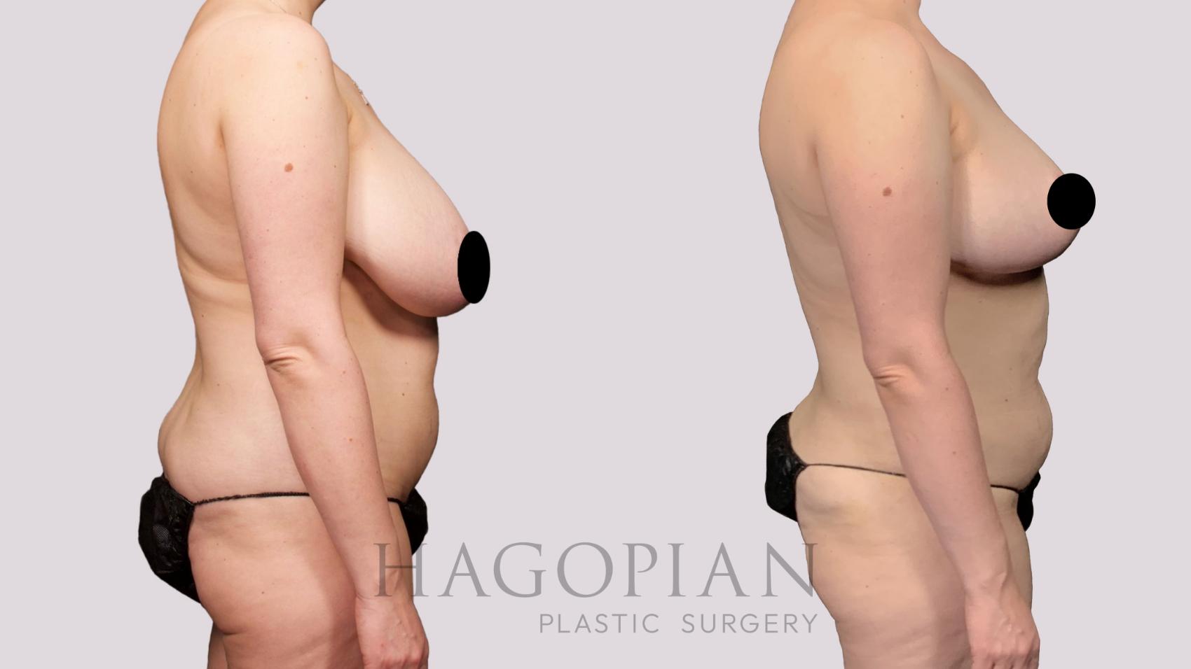 Before & After Liposuction Case 26 Right Side View in Atlanta, GA
