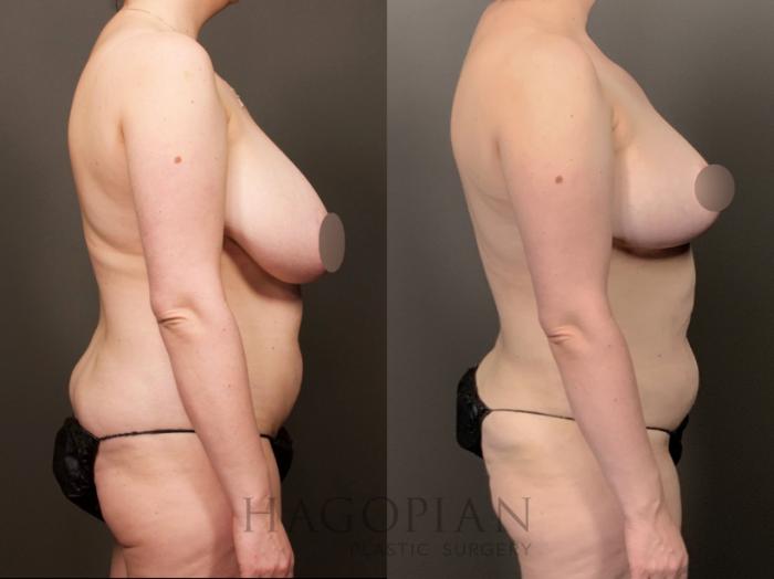 Before & After Breast Reduction Case 26 Right Side View in Atlanta, GA