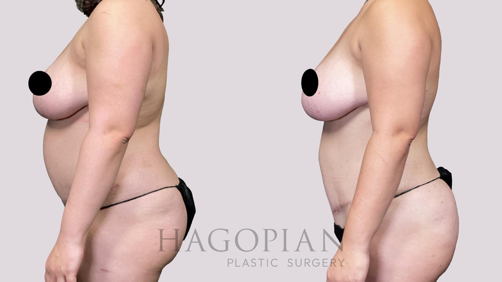 Before & After Liposuction Case 30 Left Side View in Atlanta, GA