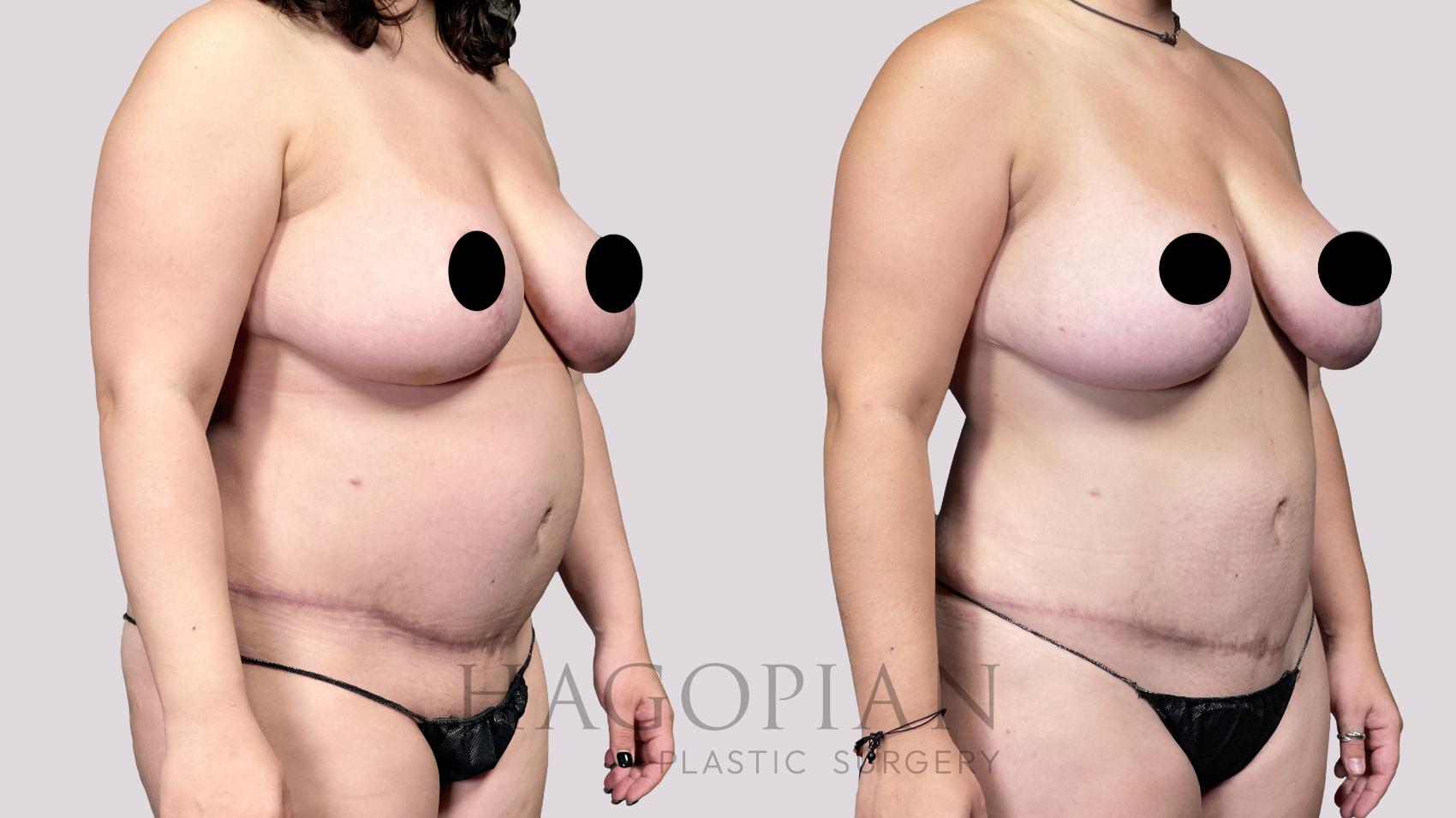 Before & After Liposuction Case 30 Right Oblique View in Atlanta, GA