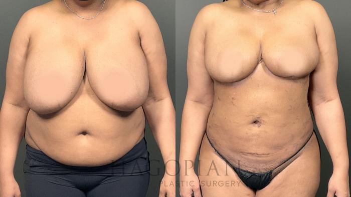 Before & After Breast Reduction Case 59 Front View in Atlanta, GA