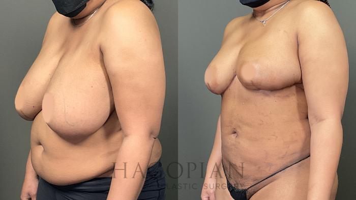 Before & After Breast Reduction Case 59 Left Oblique View in Atlanta, GA
