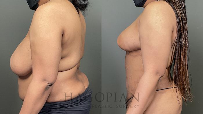 Before & After Breast Reduction Case 59 Left Side View in Atlanta, GA