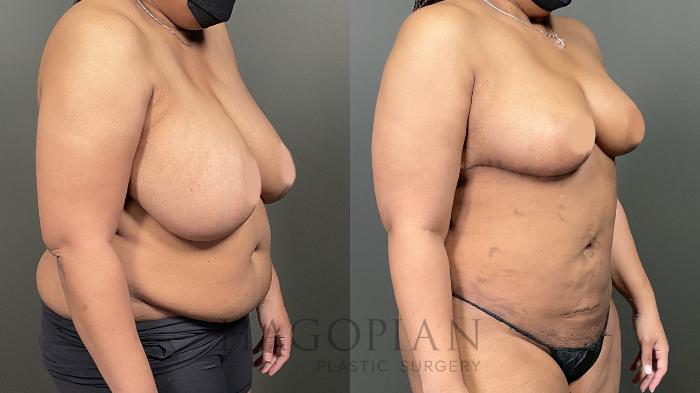 Before & After Breast Reduction Case 59 Right Oblique View in Atlanta, GA