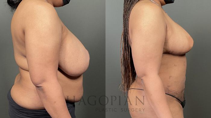 Before & After Breast Reduction Case 59 Right Side View in Atlanta, GA