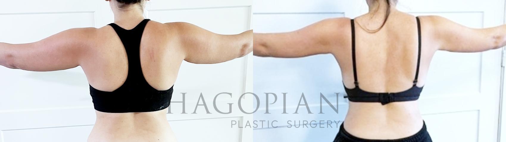 Before & After Liposuction Case 99 Back View in Atlanta, GA