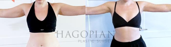 Before & After Skin Tightening Case 99 Front View in Atlanta, GA
