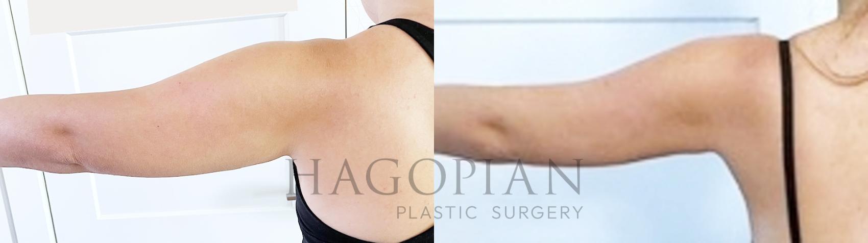Before & After Liposuction Case 99 Left Side View in Atlanta, GA