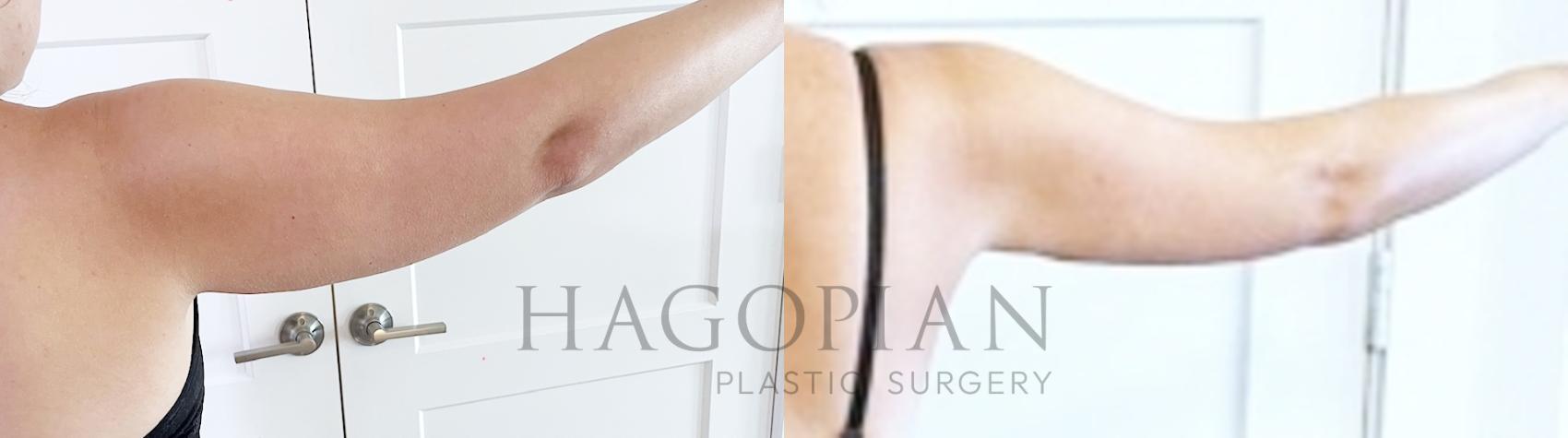 Before & After Liposuction Case 99 Right Side View in Atlanta, GA