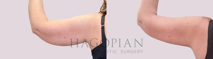 Before & After Skin Tightening Case 246 Back Left View in Atlanta, GA