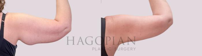 Before & After Skin Tightening Case 246 Back Right View in Atlanta, GA