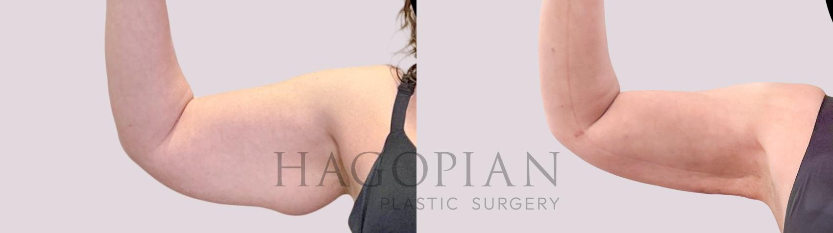 Before & After Skin Tightening Case 246 Front Left View in Atlanta, GA