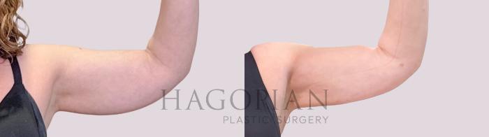 Before & After Skin Tightening Case 246 Front Right View in Atlanta, GA
