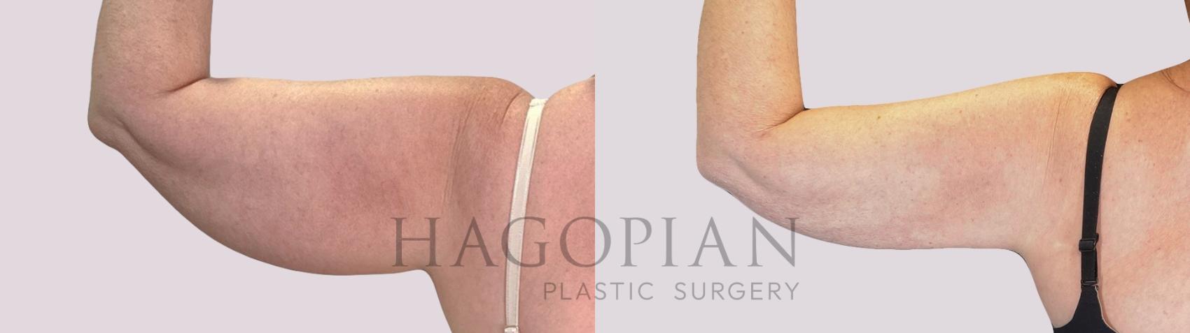 Before & After Skin Tightening Case 253 Back Left View in Atlanta, GA