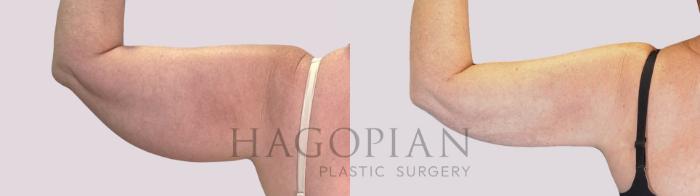 Before & After Skin Tightening Case 253 Back Left View in Atlanta, GA
