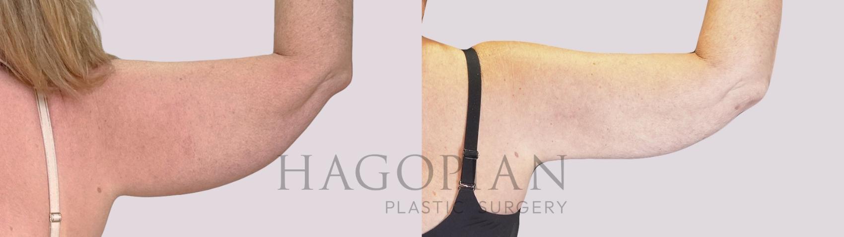Before & After Skin Tightening Case 253 Back Right View in Atlanta, GA