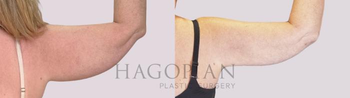 Before & After Skin Tightening Case 253 Back Right View in Atlanta, GA