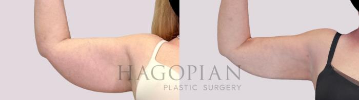 Before & After Skin Tightening Case 253 Front Left View in Atlanta, GA