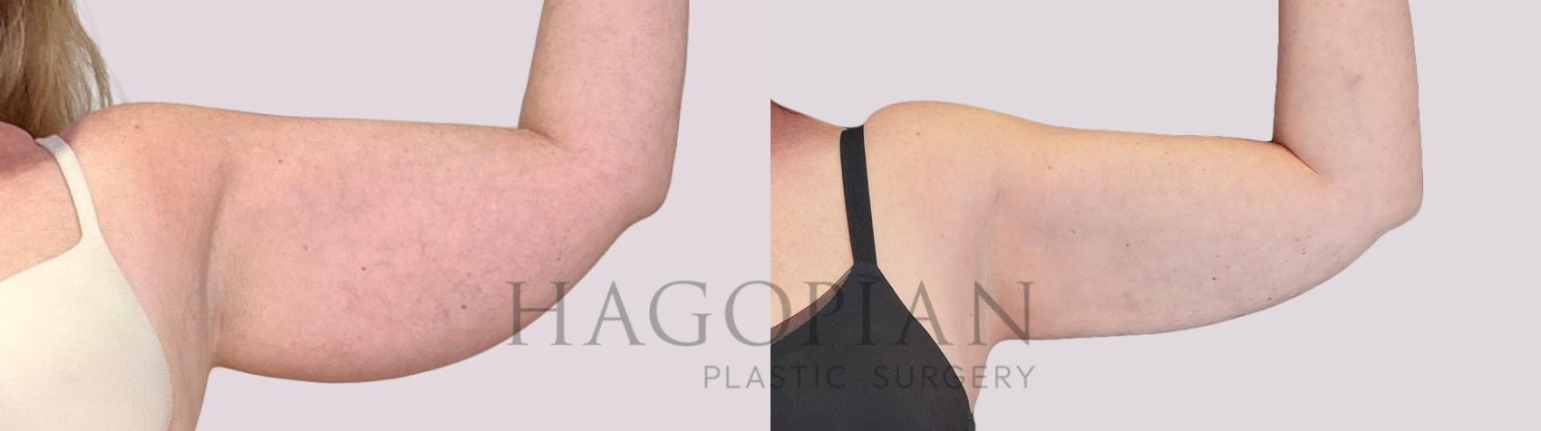 Before & After Skin Tightening Case 253 Front Right View in Atlanta, GA