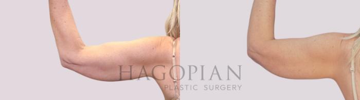 Before & After Skin Tightening Case 264 Back Left View in Atlanta, GA