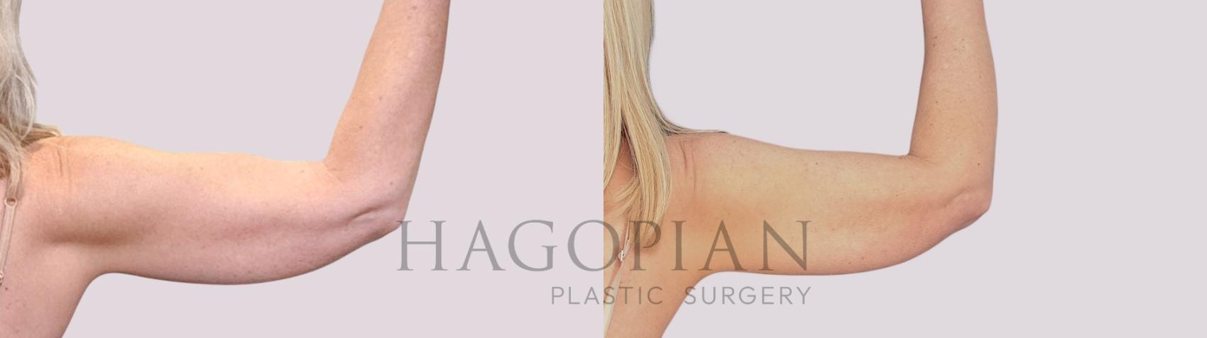 Before & After Skin Tightening Case 264 Back Right View in Atlanta, GA