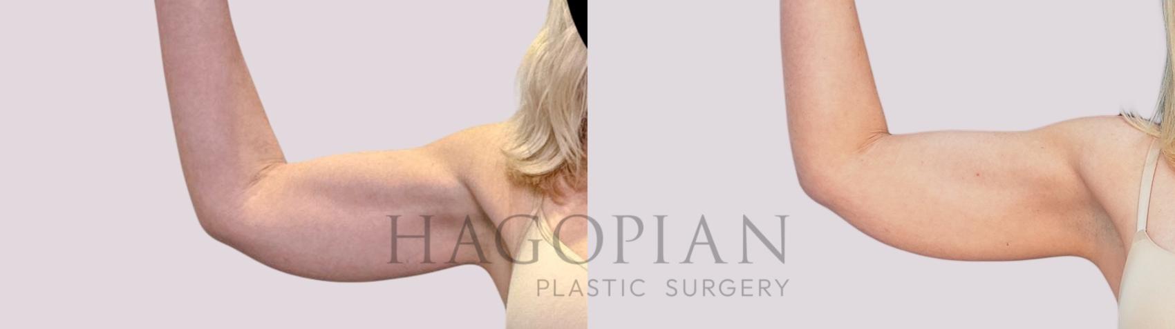 Before & After Skin Tightening Case 264 Front Left View in Atlanta, GA