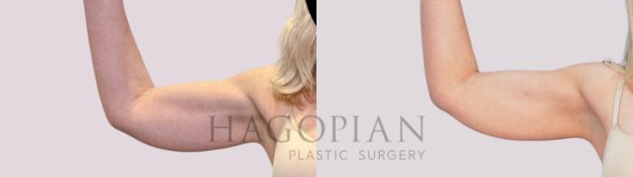 Before & After Skin Tightening Case 264 Front Left View in Atlanta, GA