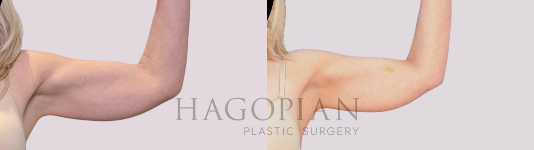 Before & After Skin Tightening Case 264 Front Right View in Atlanta, GA