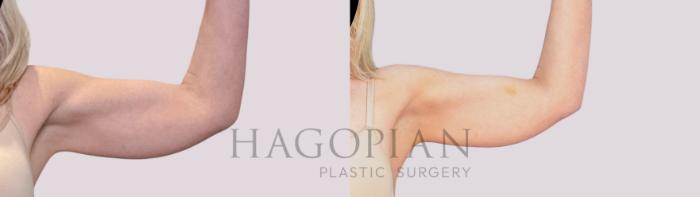 Before & After Skin Tightening Case 264 Front Right View in Atlanta, GA